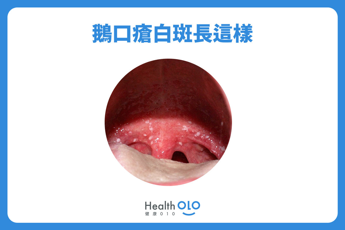 鵝口瘡白班長這樣