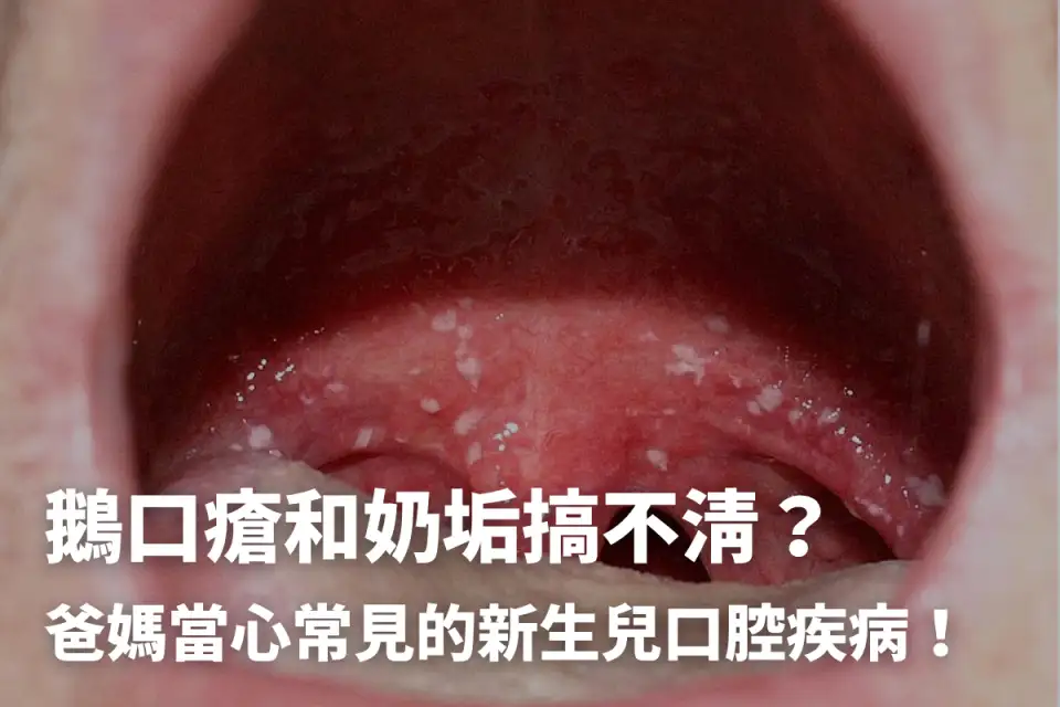 鵝口瘡奶垢分不清？要看醫生嗎？爸媽必知5個照護重點