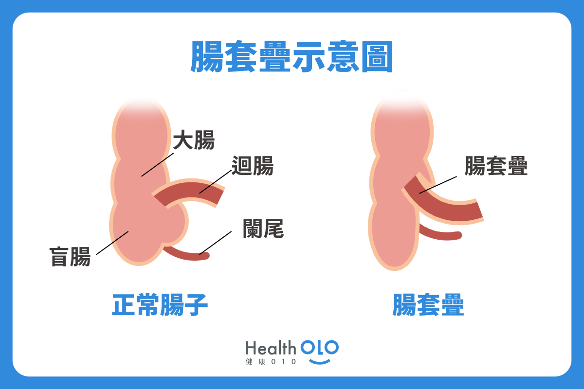 腸套疊示意圖