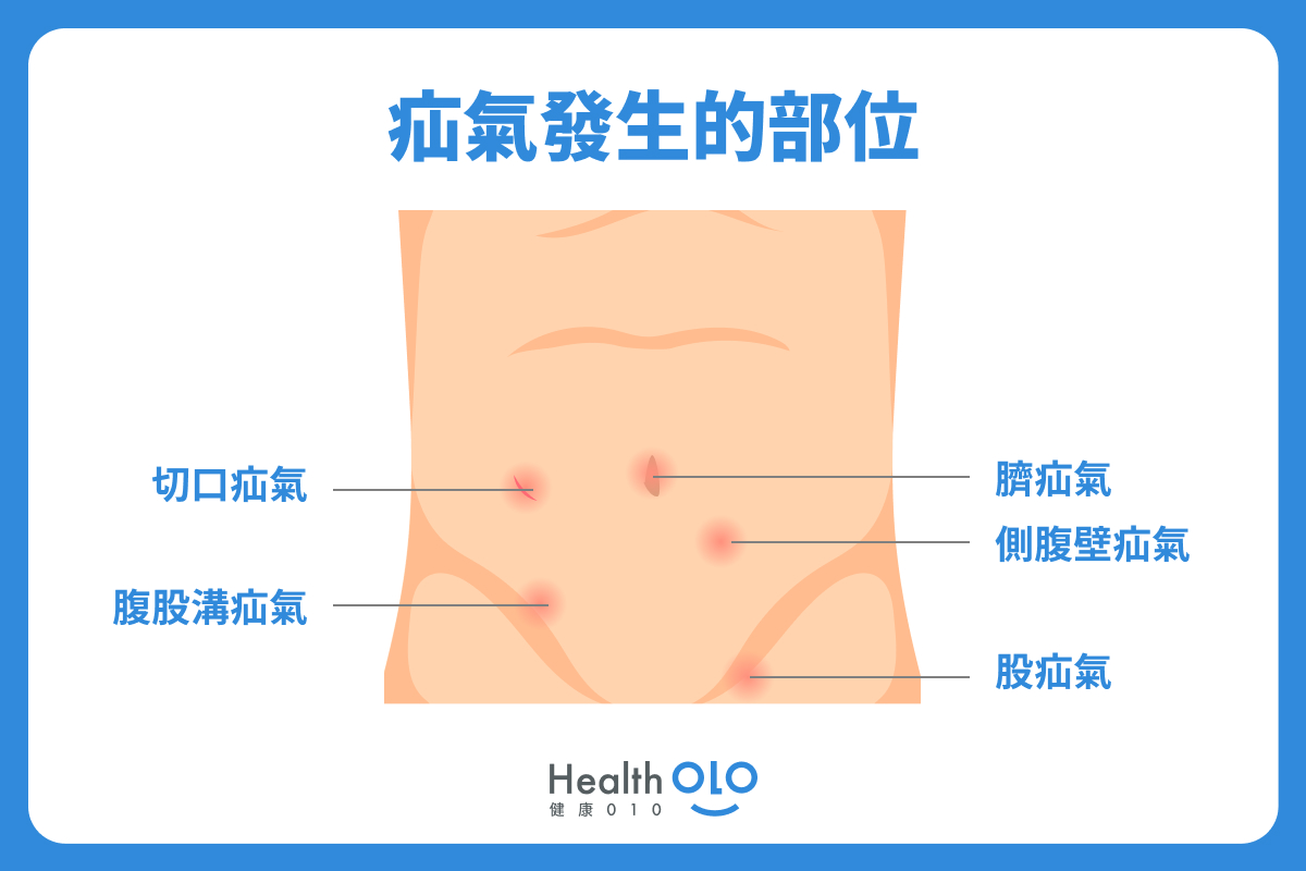 疝氣發生的部位