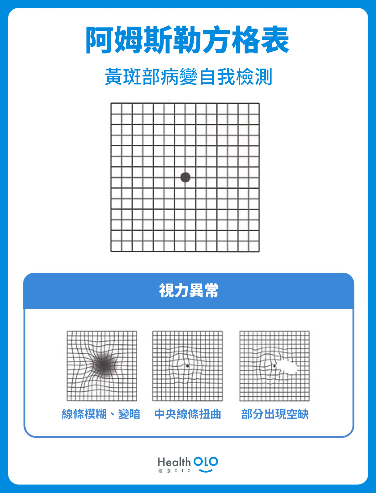 黃斑部病變的自我檢測工具：阿姆斯勒量表Amsler Grid