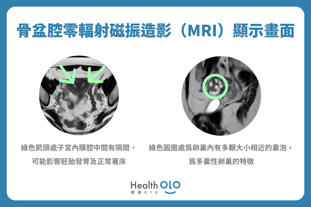 骨盆腔零輻射核磁共振（MRI）顯示畫面