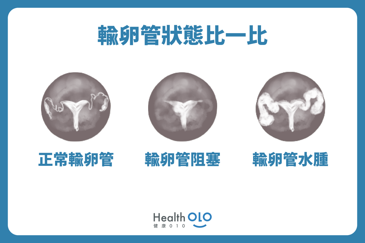 輸卵管狀態比一比