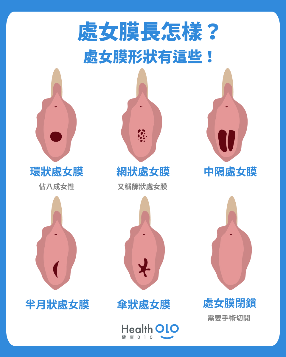 處女膜形狀