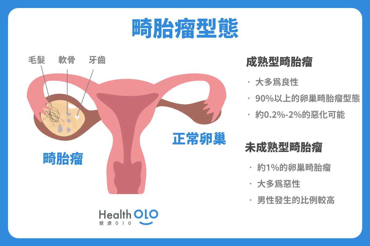 畸胎瘤型態