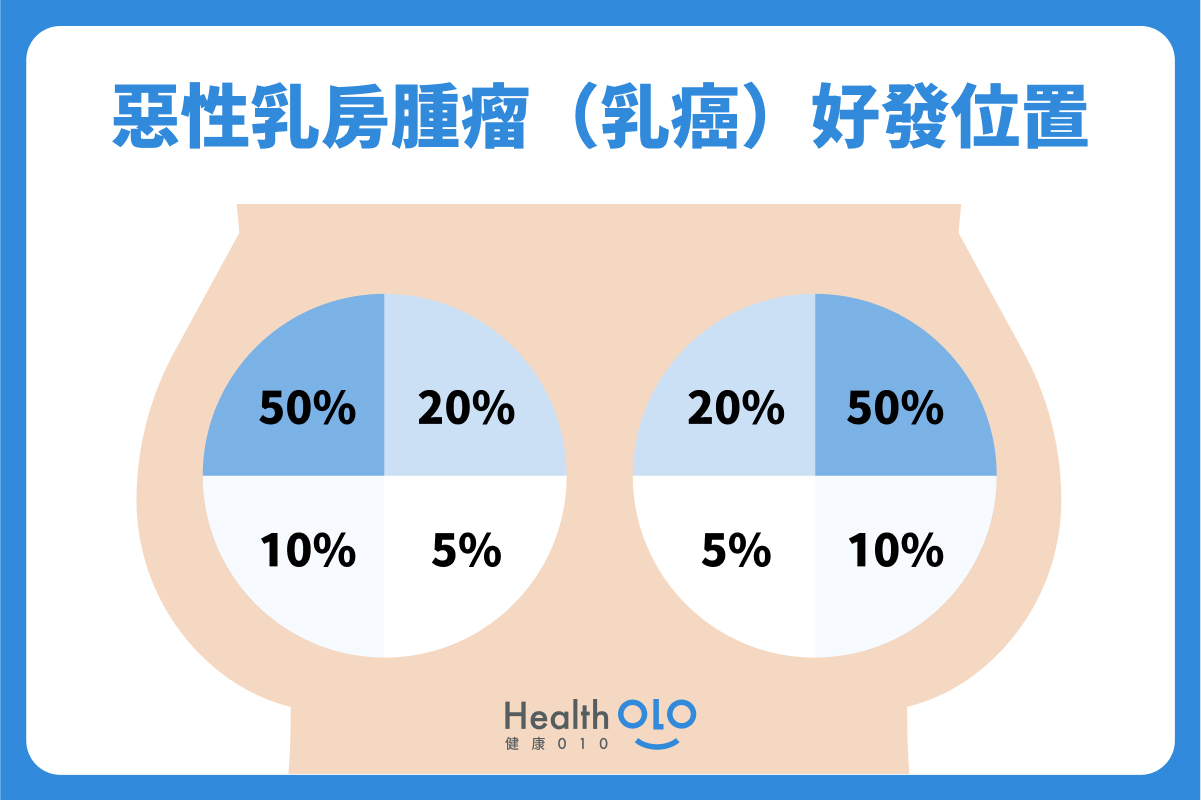 惡性乳房腫瘤（乳癌）好發位置