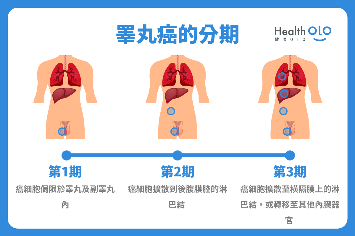 睪丸癌的分期