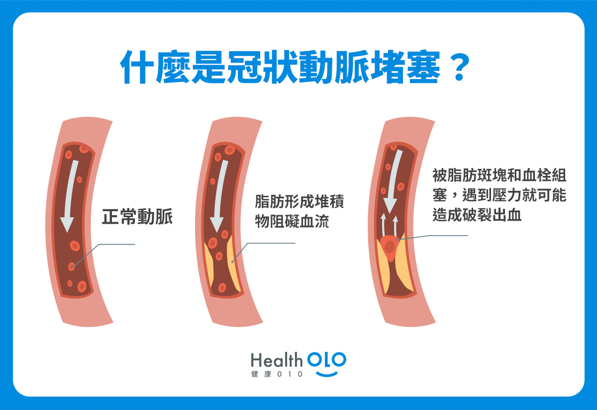 什麼是冠狀動脈堵塞